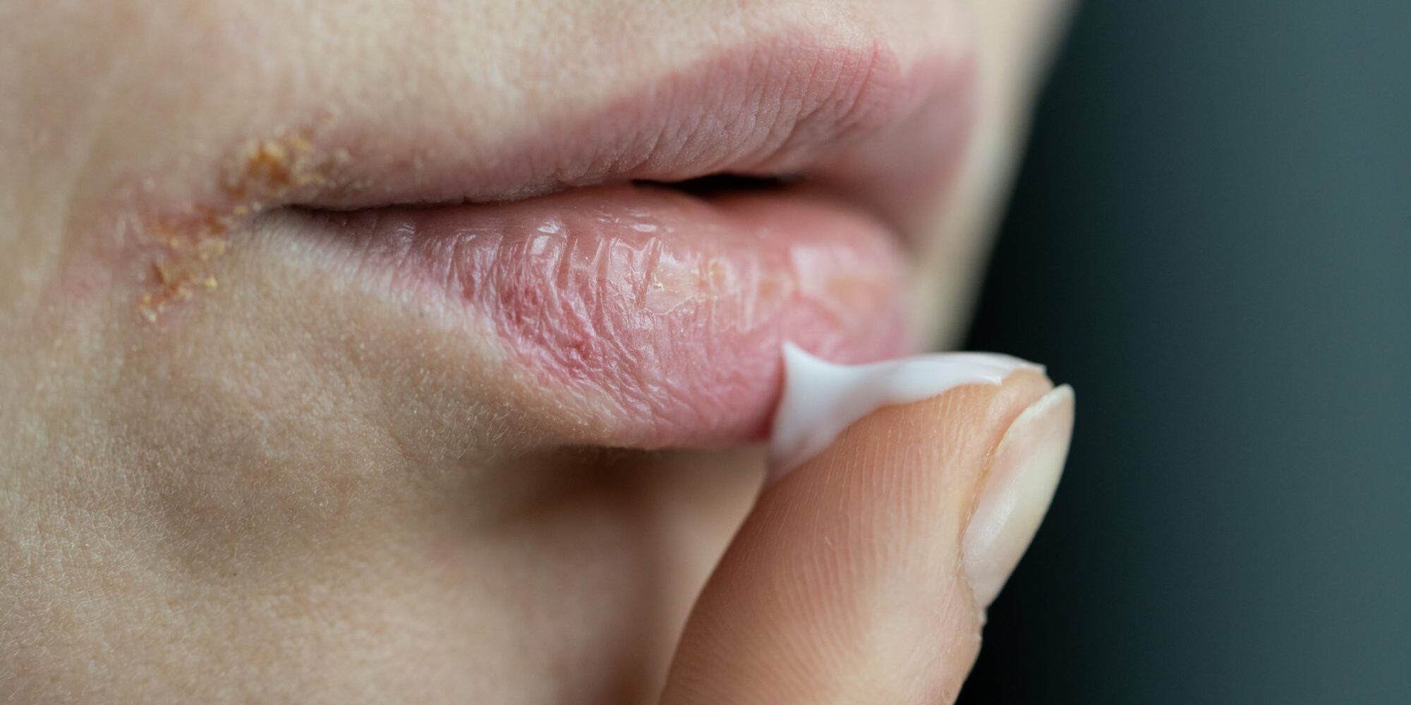 Eine Hand trägt Lippenpflege auf spröde Lippen auf, sichtbar sind trockene Hautstellen.