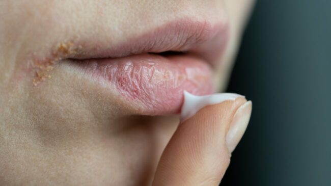 Eine Hand trägt Lippenpflege auf spröde Lippen auf, sichtbar sind trockene Hautstellen.